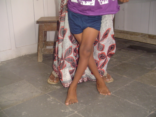 Cerebral Palsy Symptoms