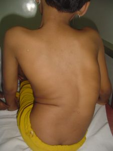 Scoliosis Curvature Of Spine