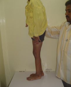 Tendoachilles Contracture After