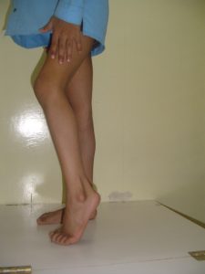 Tendoachilles Contracture Before