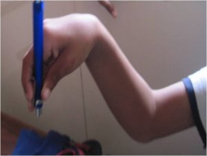 Upper Limb Deformity